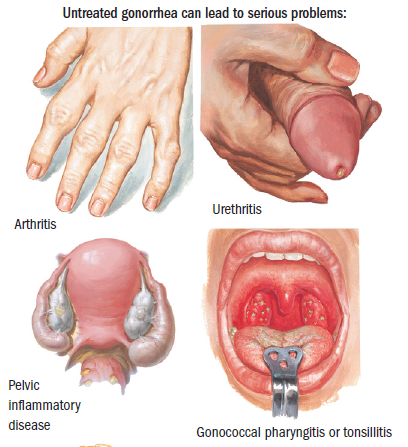 Symptoms of gonorrhea